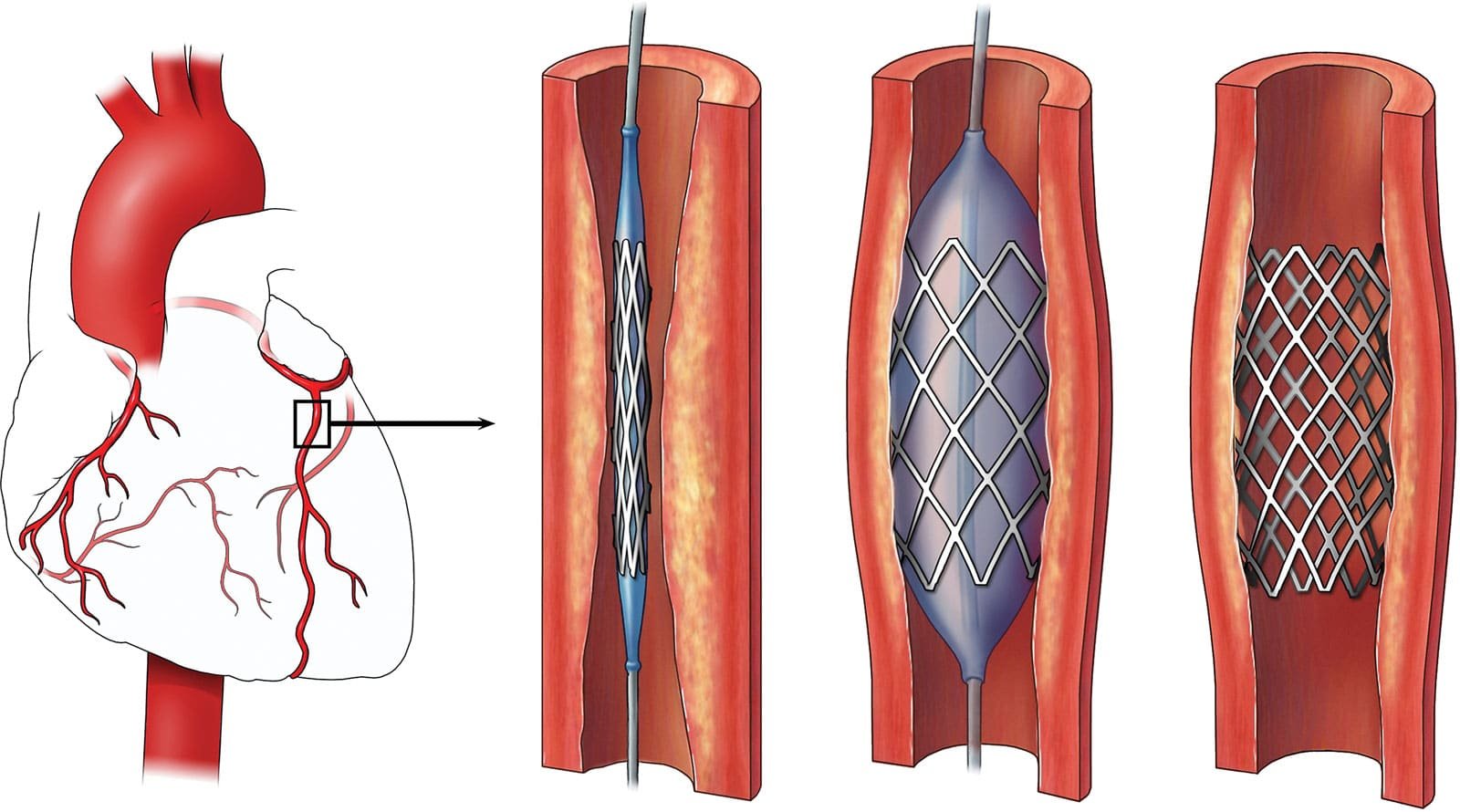 Cardiac Stent