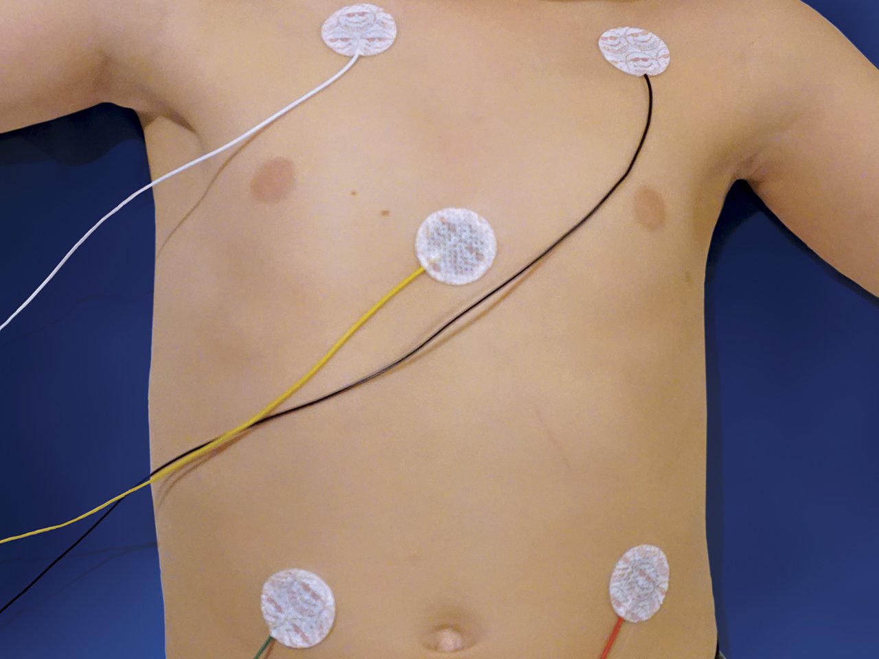 ECG Electrodes
