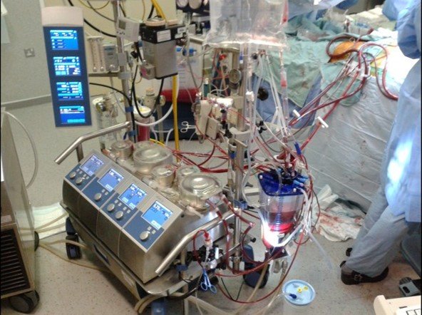 Heart-Lung Machine