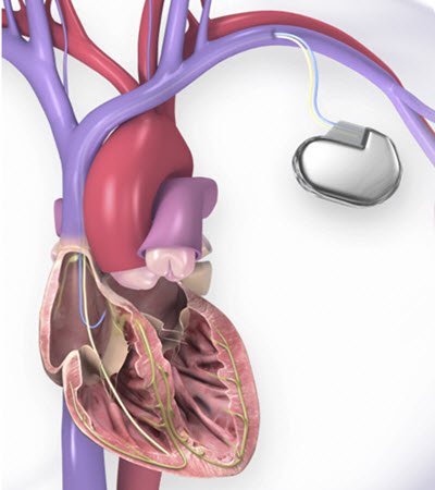Implantable Cardioverter Defibrillator (ICD)