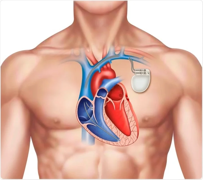 Pacemaker