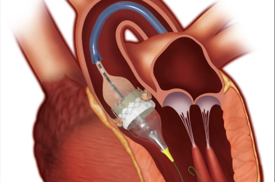 Transcatheter Aortic Valve Replacement (TAVR)