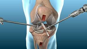 Arthroscopy/ACL/PCL