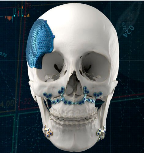 Craniomaxillofacial Implants