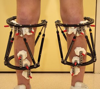 External Fixators
