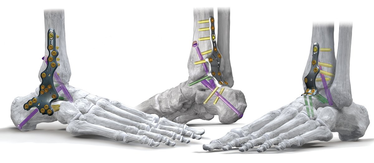 Foot and Ankle System