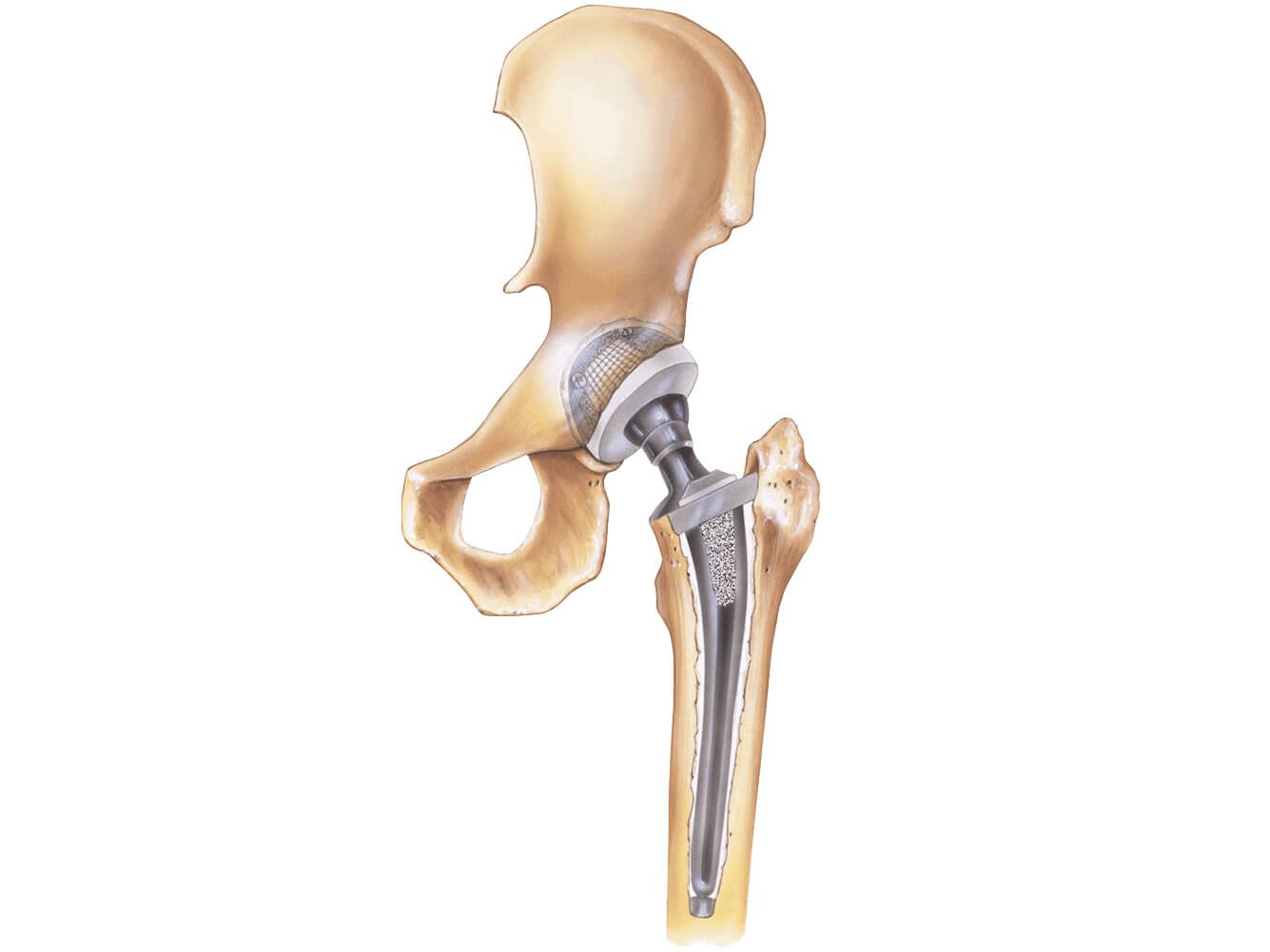 Hip Prosthesis