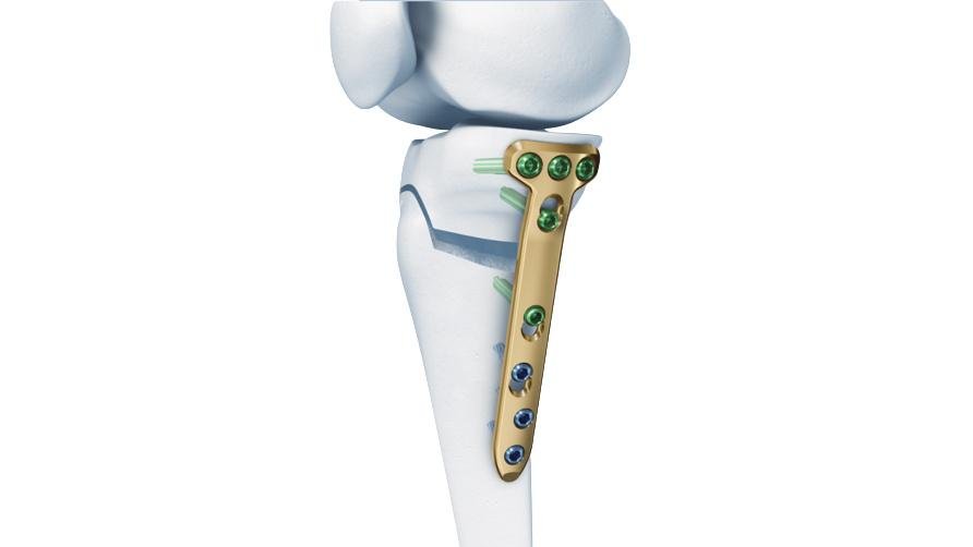 Knee Osteotomy Plates System