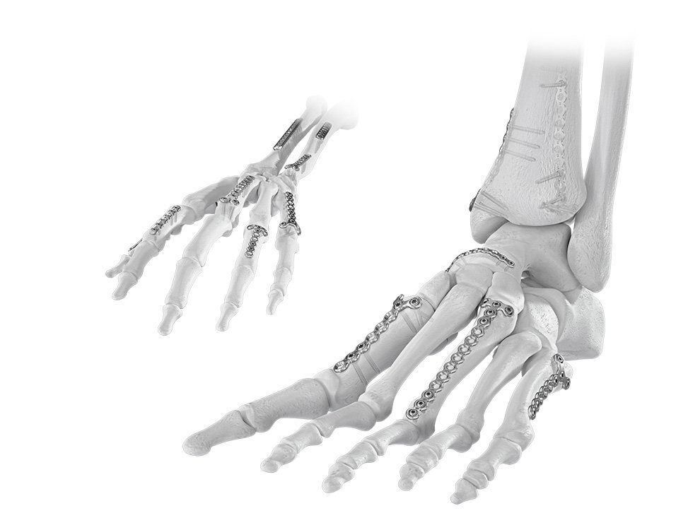 Mini Fragment (Hand and Foot)